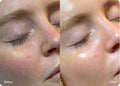 Hydrafacial