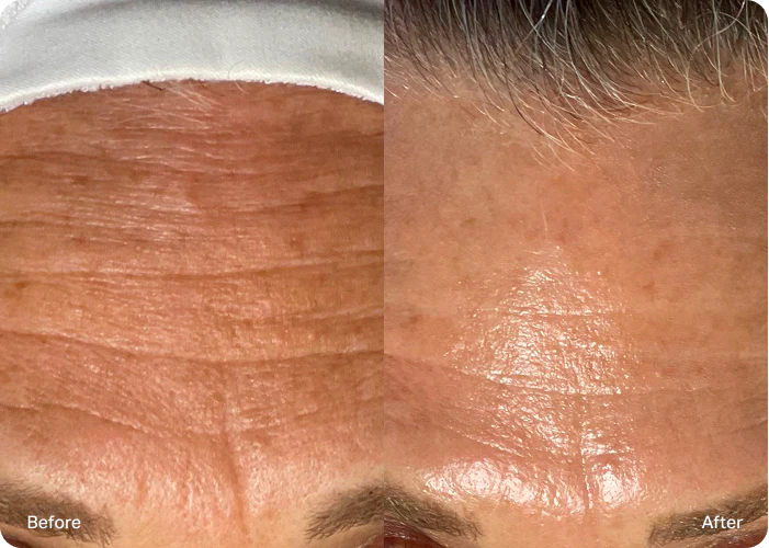 Hydrafacial