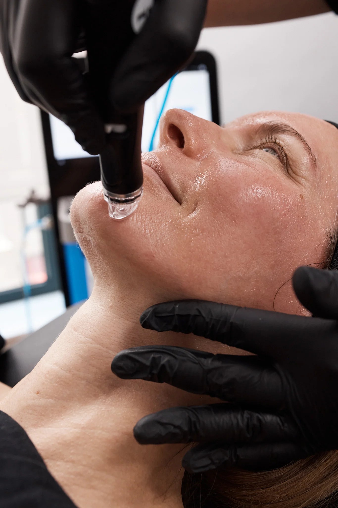 Hydrafacial