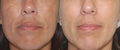 Laser Facial Toning