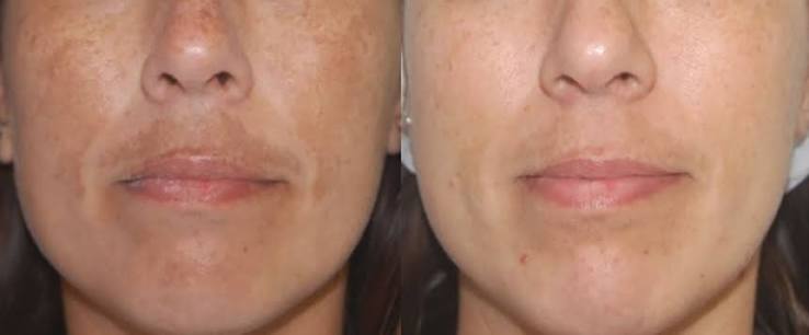 Laser Facial Toning