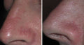 Laser For Hemangioma / Veins