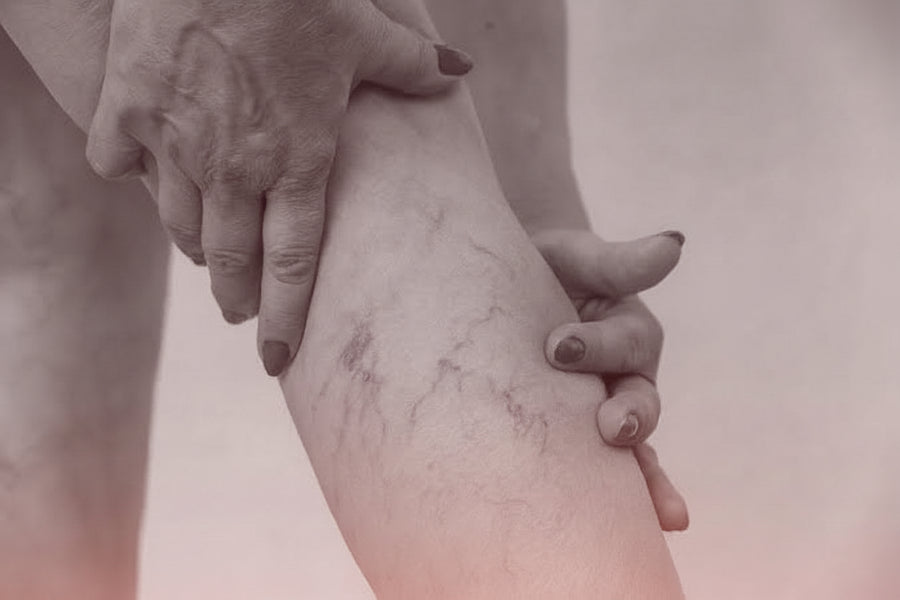 Hemangioma & Vascular Lesions