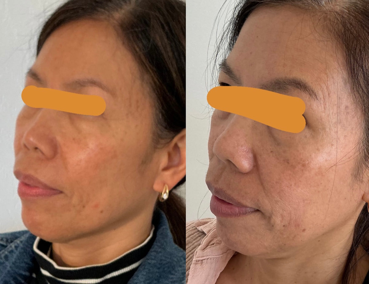 Microneedling + Chemical Peel | Package