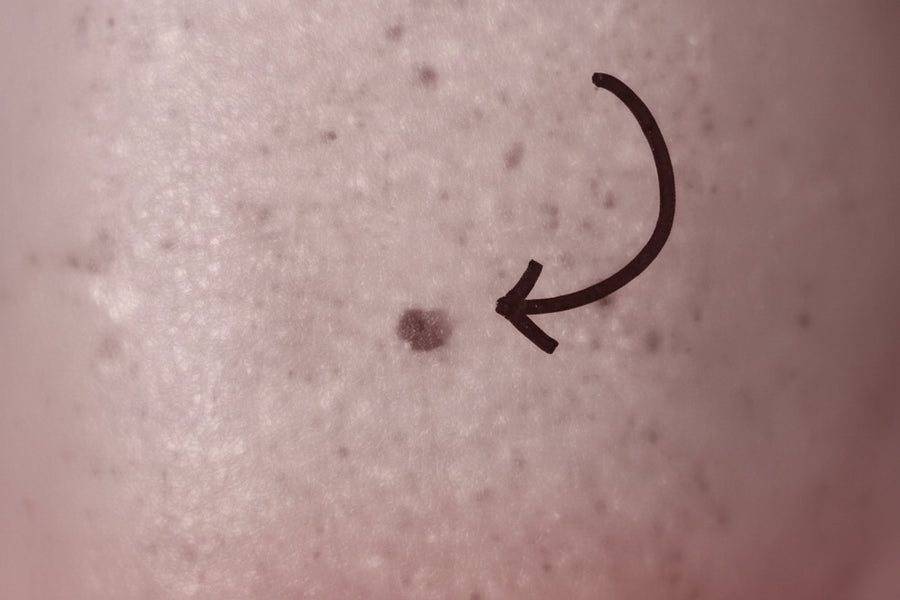 Pigmentation