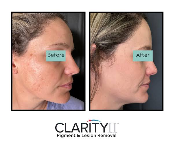 Laser Facial Toning