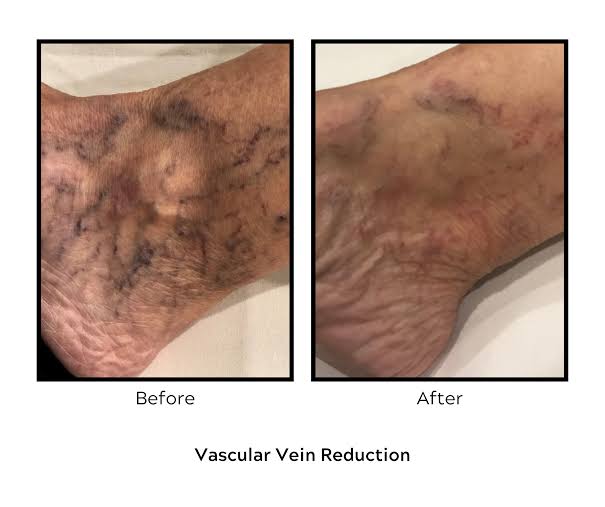 Laser For Hemangioma / Veins