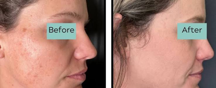 Laser Toning Package