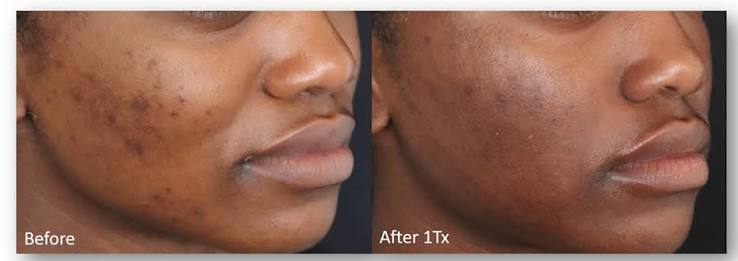 Laser Facial Toning