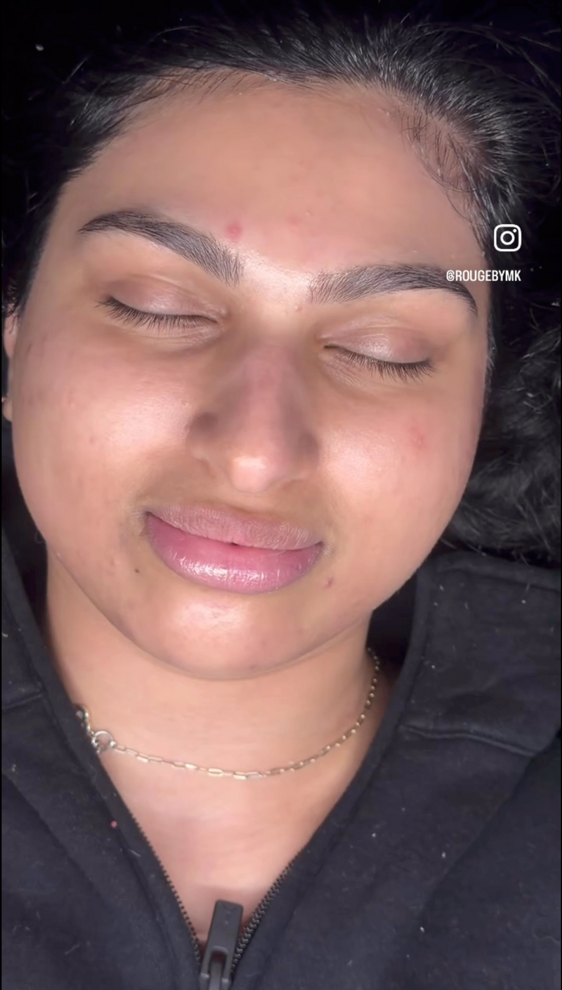 Hydrafacial