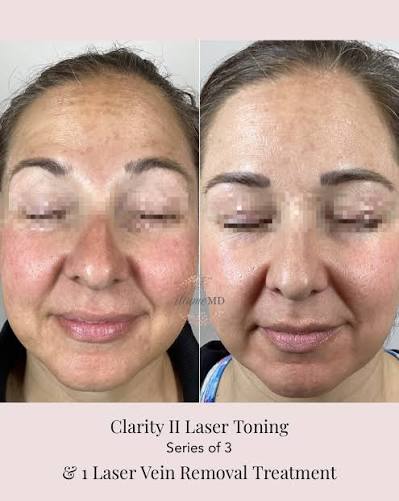 Laser Facial Toning