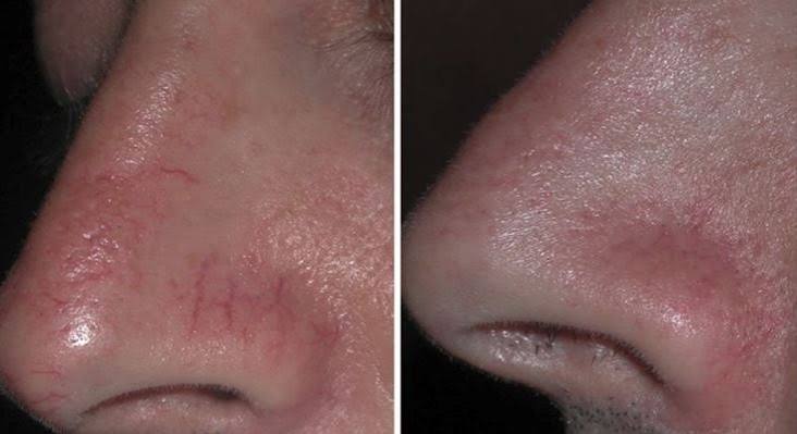 Laser For Hemangioma / Veins