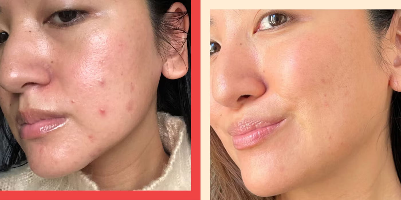 Microneedling