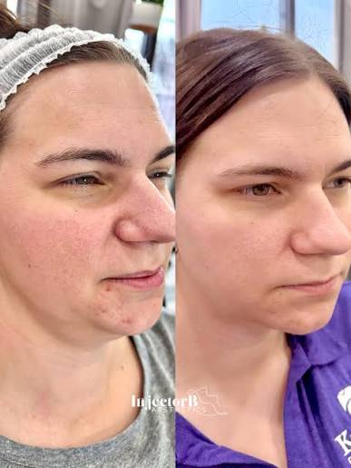 Laser Facial Toning