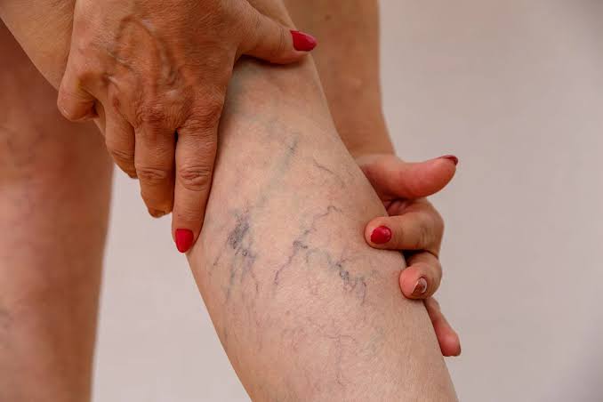 Laser For Hemangioma / Veins