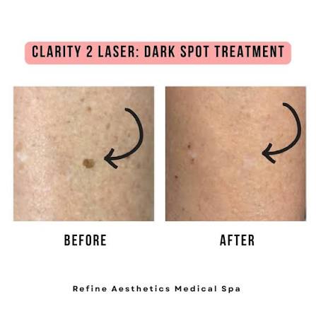 Laser For Pigmentation