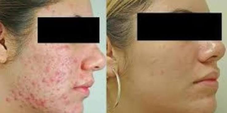 Laser Facial Toning