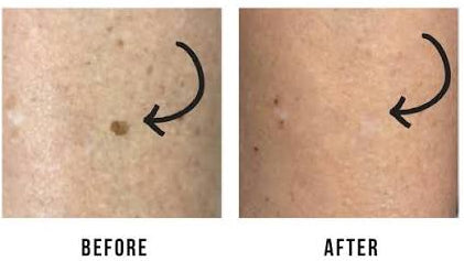 Clarity II Laser Toning Treatment | Package