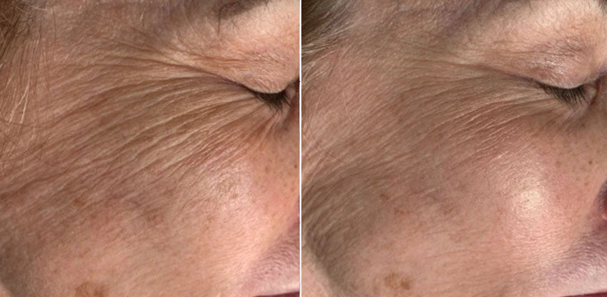 Microneedling
