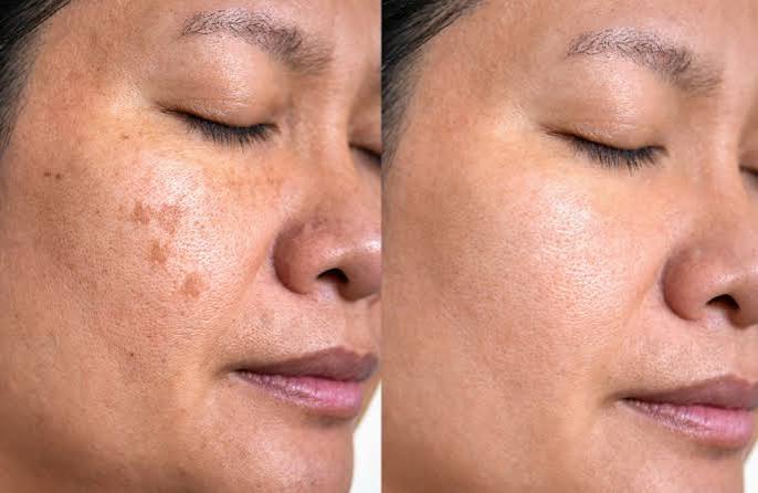 Laser For Pigmentation