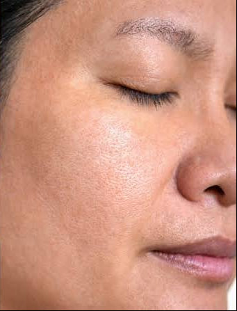 Clarity II Laser Toning Treatment | Package