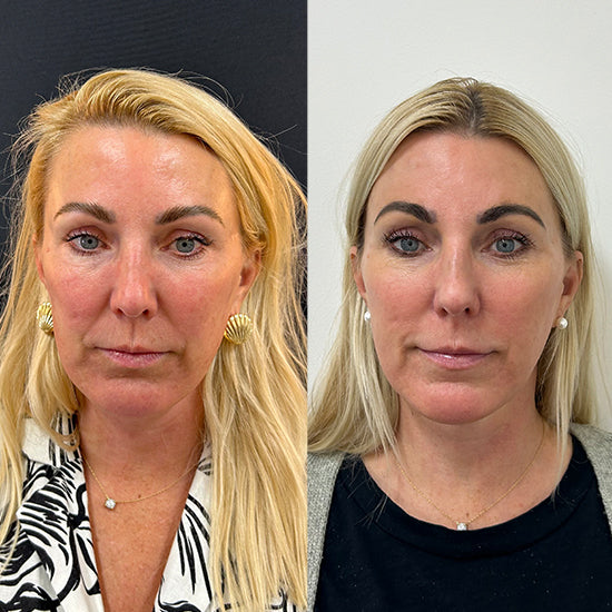 Microneedling
