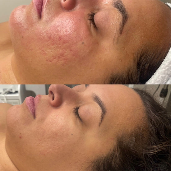 Microneedling