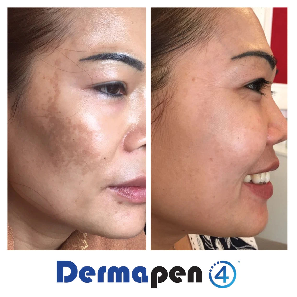 Microneedling