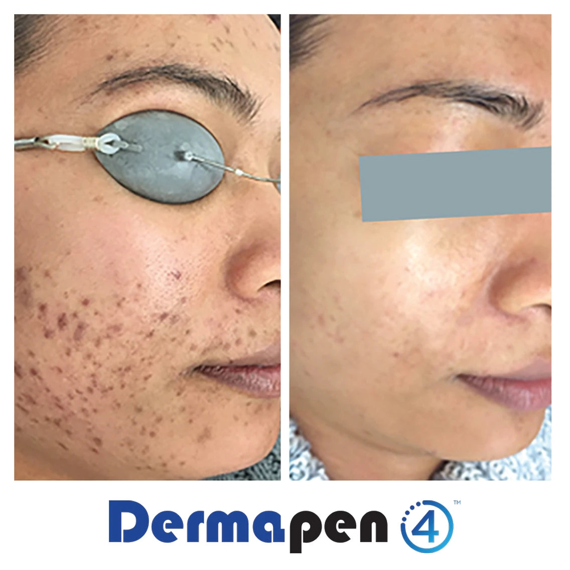 Microneedling
