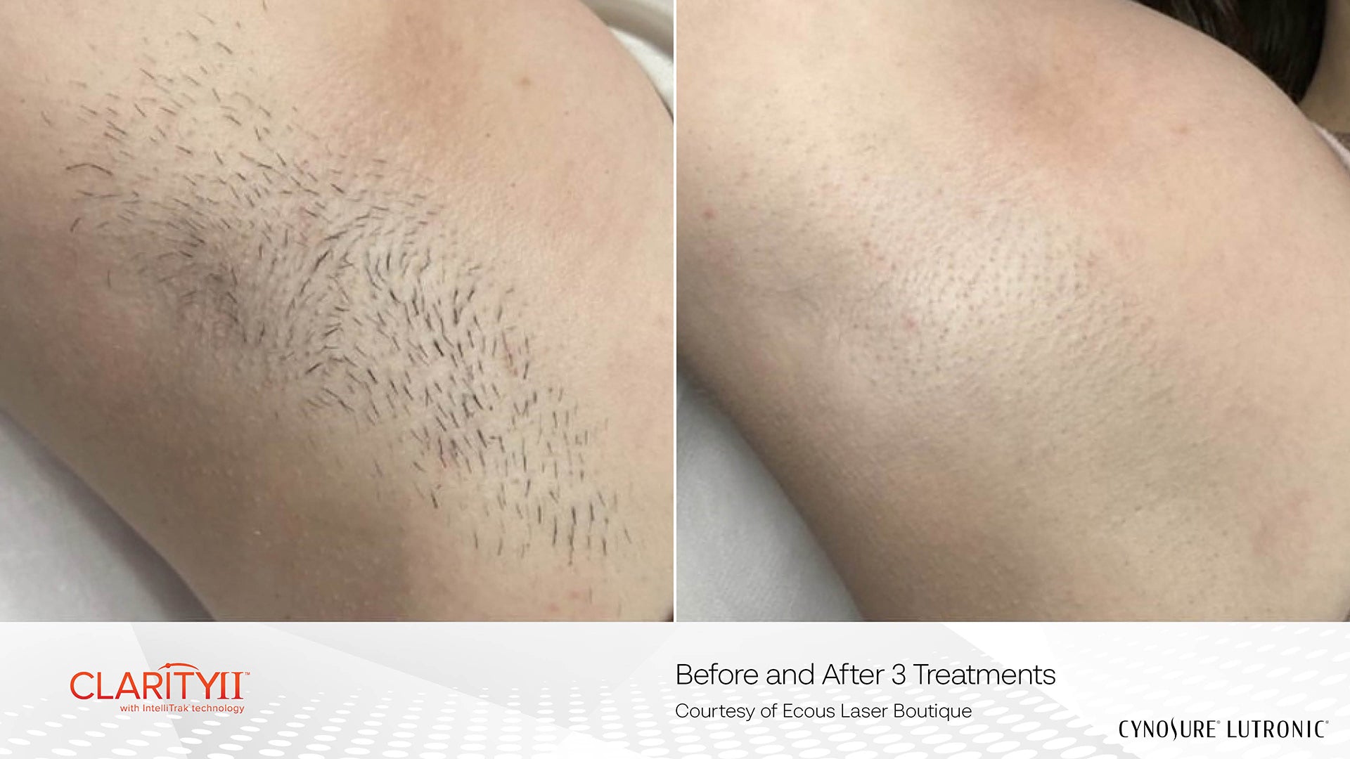 Laser Hair Removal
