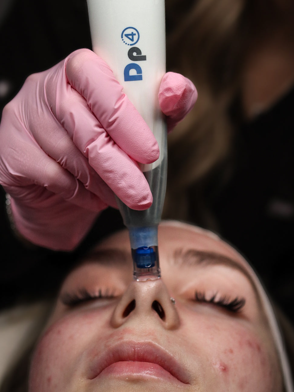 Microneedling