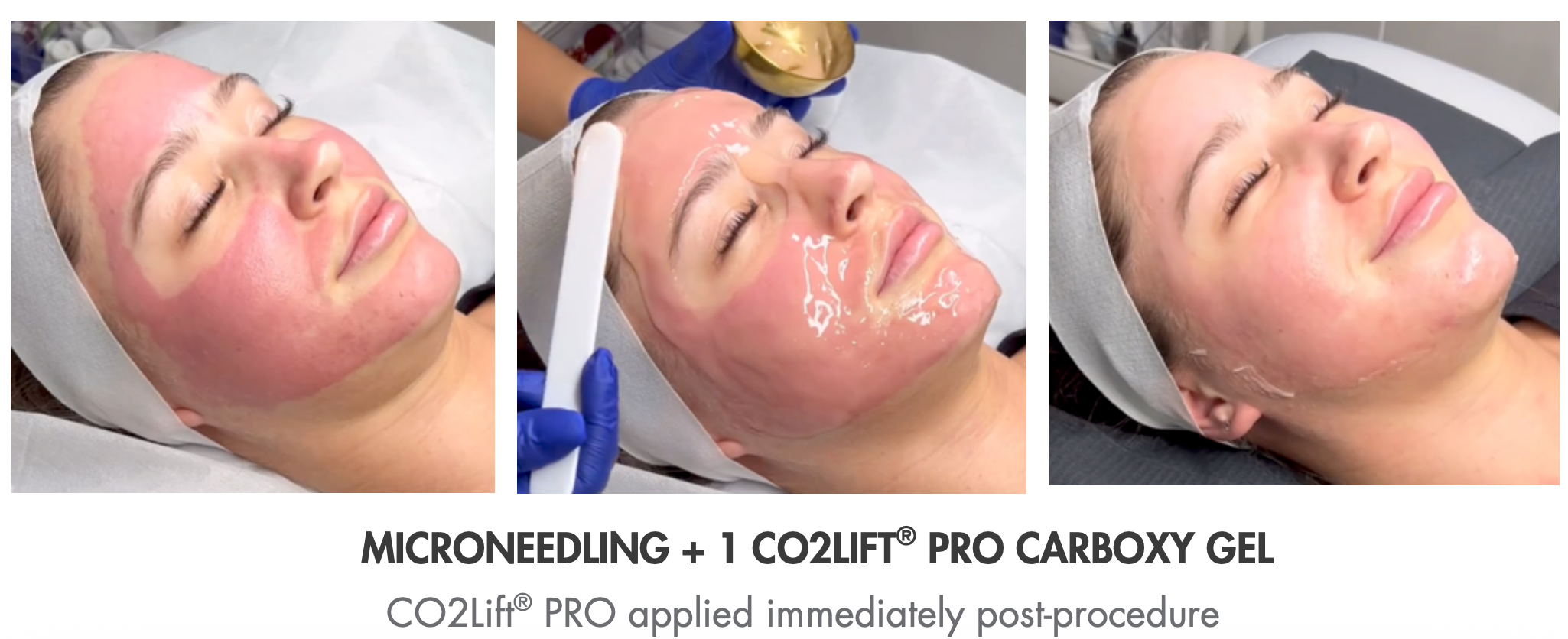 Microneedling