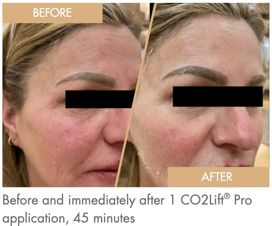 Advance Carboxy Therapy