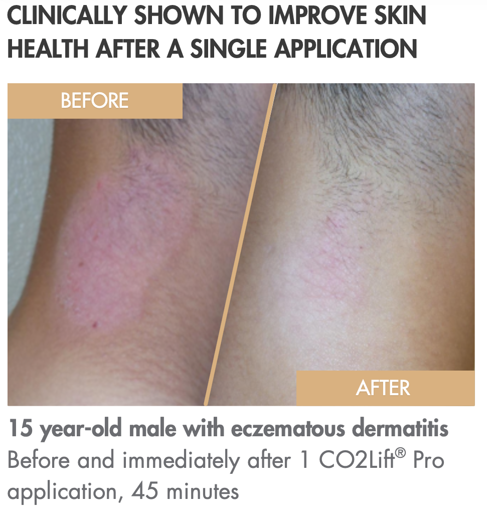 Advance Carboxy Therapy