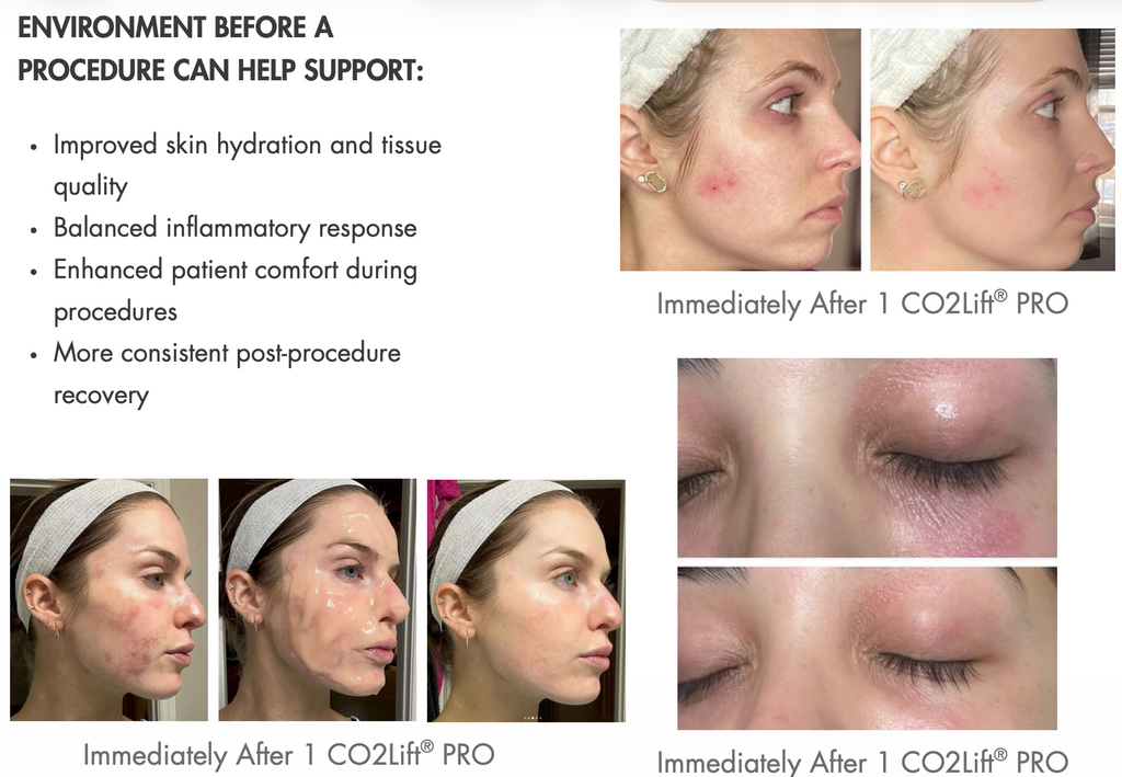 Advance Carboxy Therapy