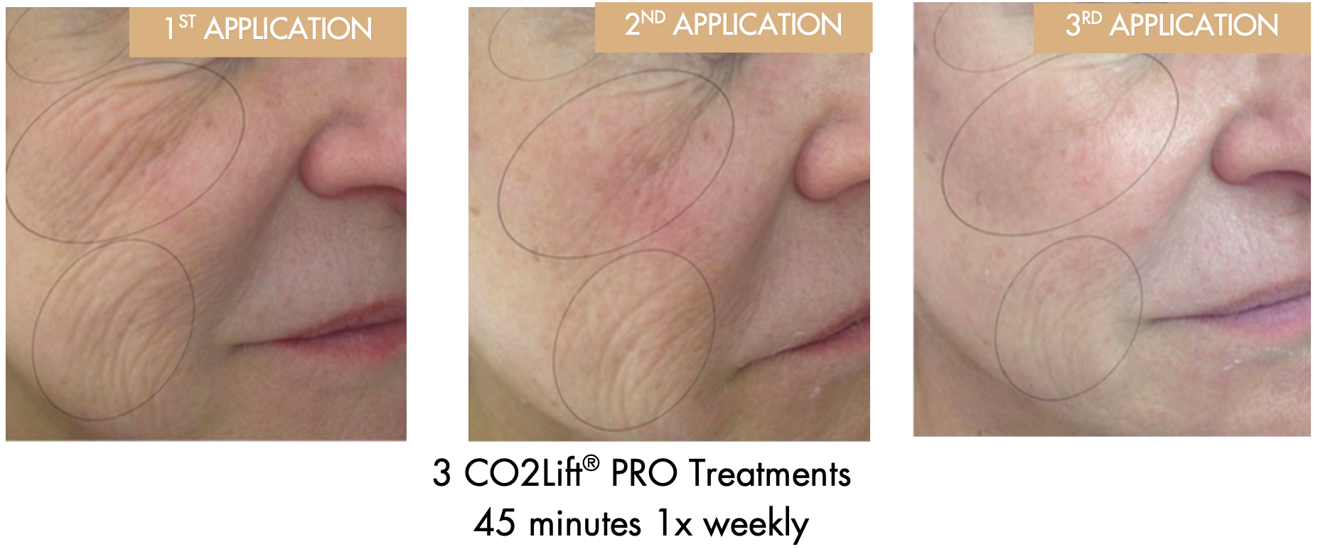 Microneedling