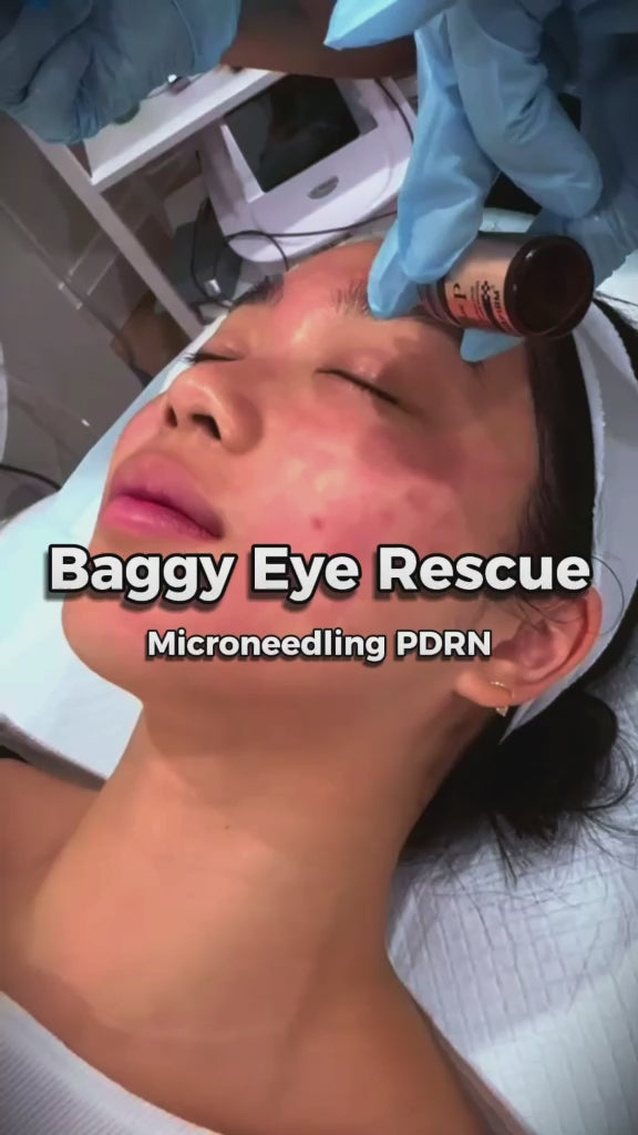 Promotion - Microneedling incl. PDRN